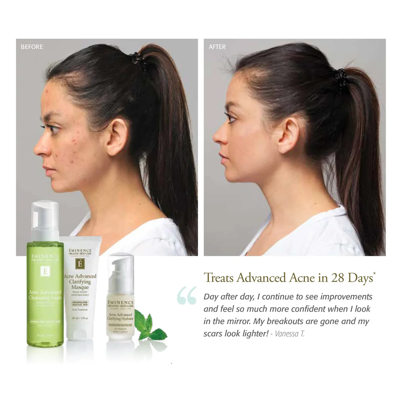 Hydratant clarifiant antiacnéique avancé